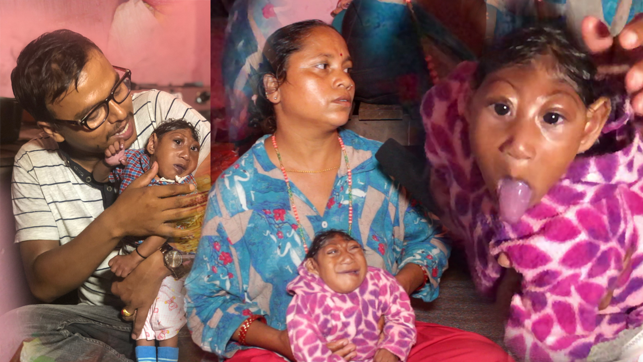 पोखरामा भेटियो एलिएन जस्तै निधार नभएको बच्चा, १४ महिनामा साढे २ किलो तौल (भिडियो)